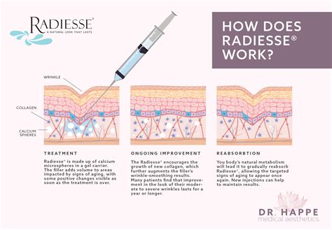 queensland radiesse|How It Works .